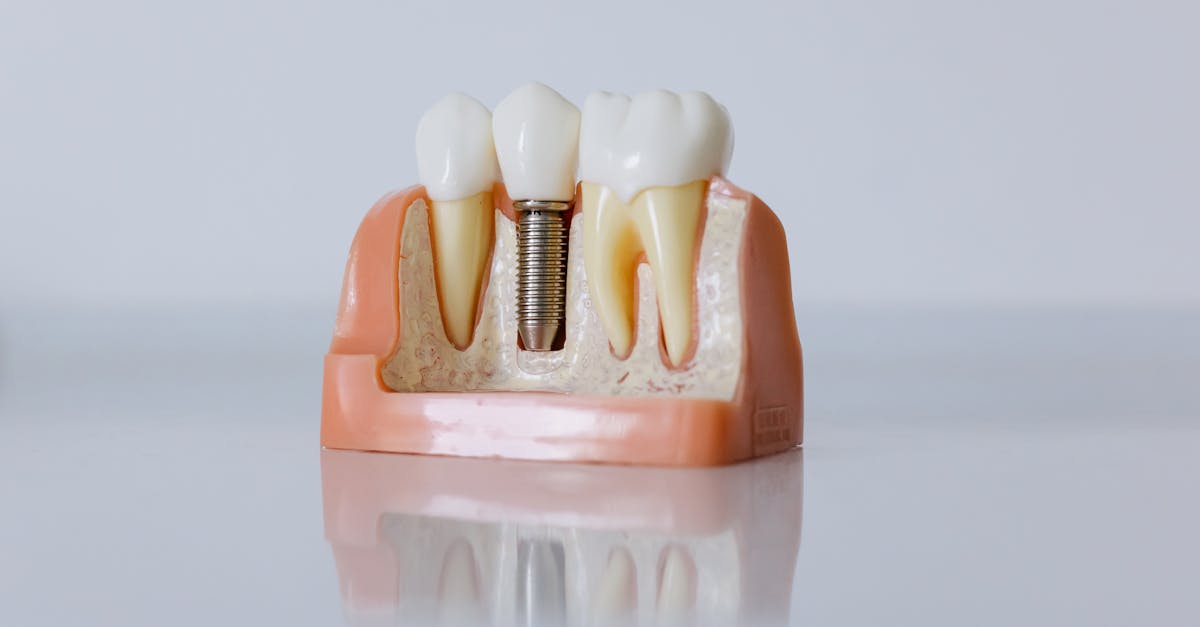 How Much Do Dental Implants Cost in 2026? Complete Price Breakdown by Type